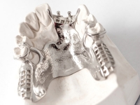 implant dentaire squelette métallique