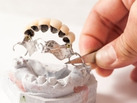 implant dentaire squelette métallique